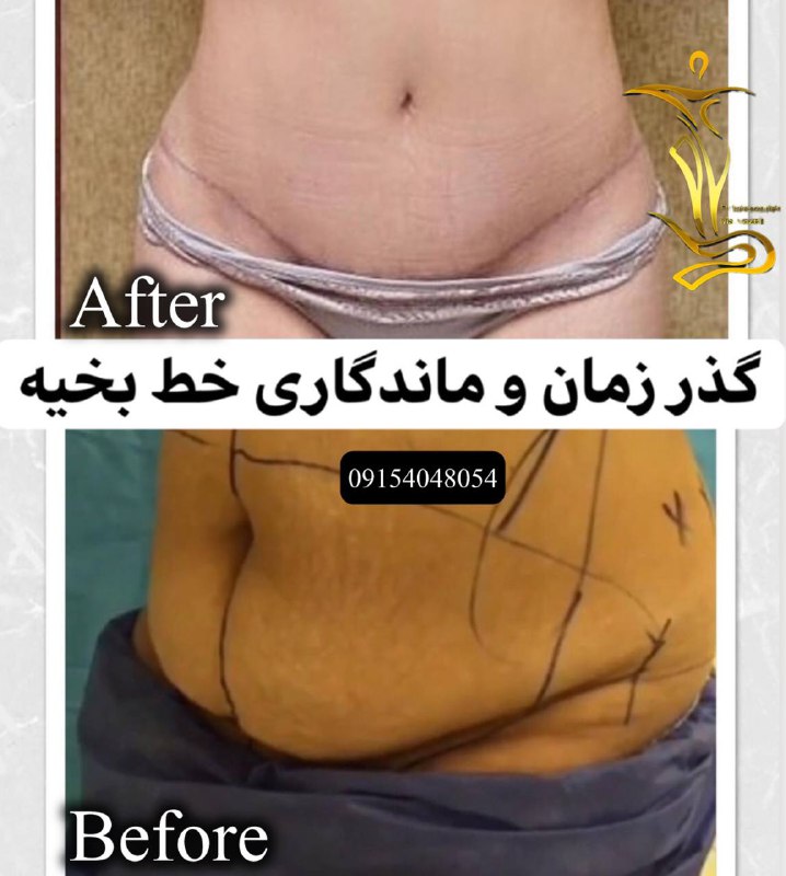 ابدومینوپلاستی