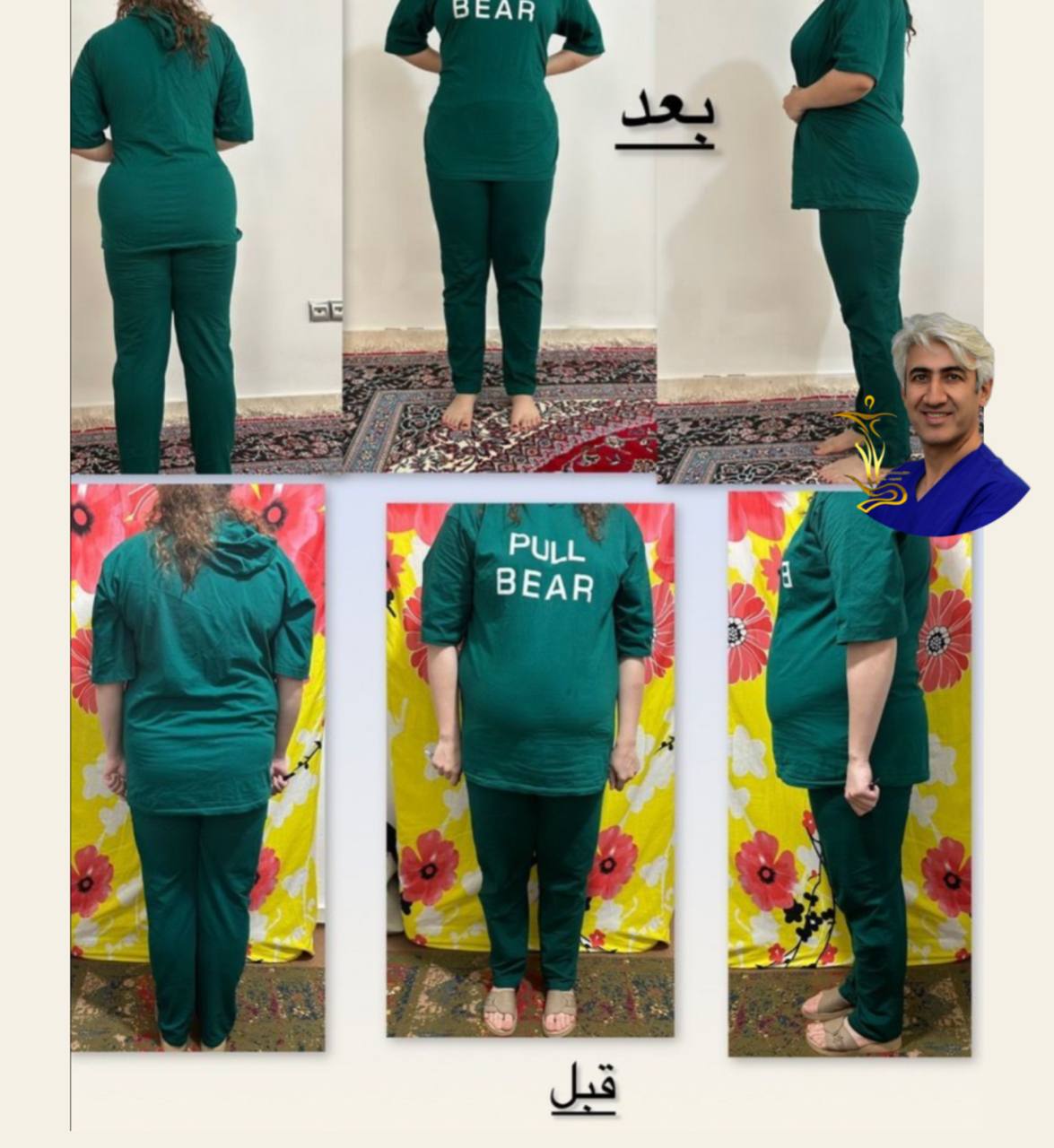 ابدومینوپلاستی