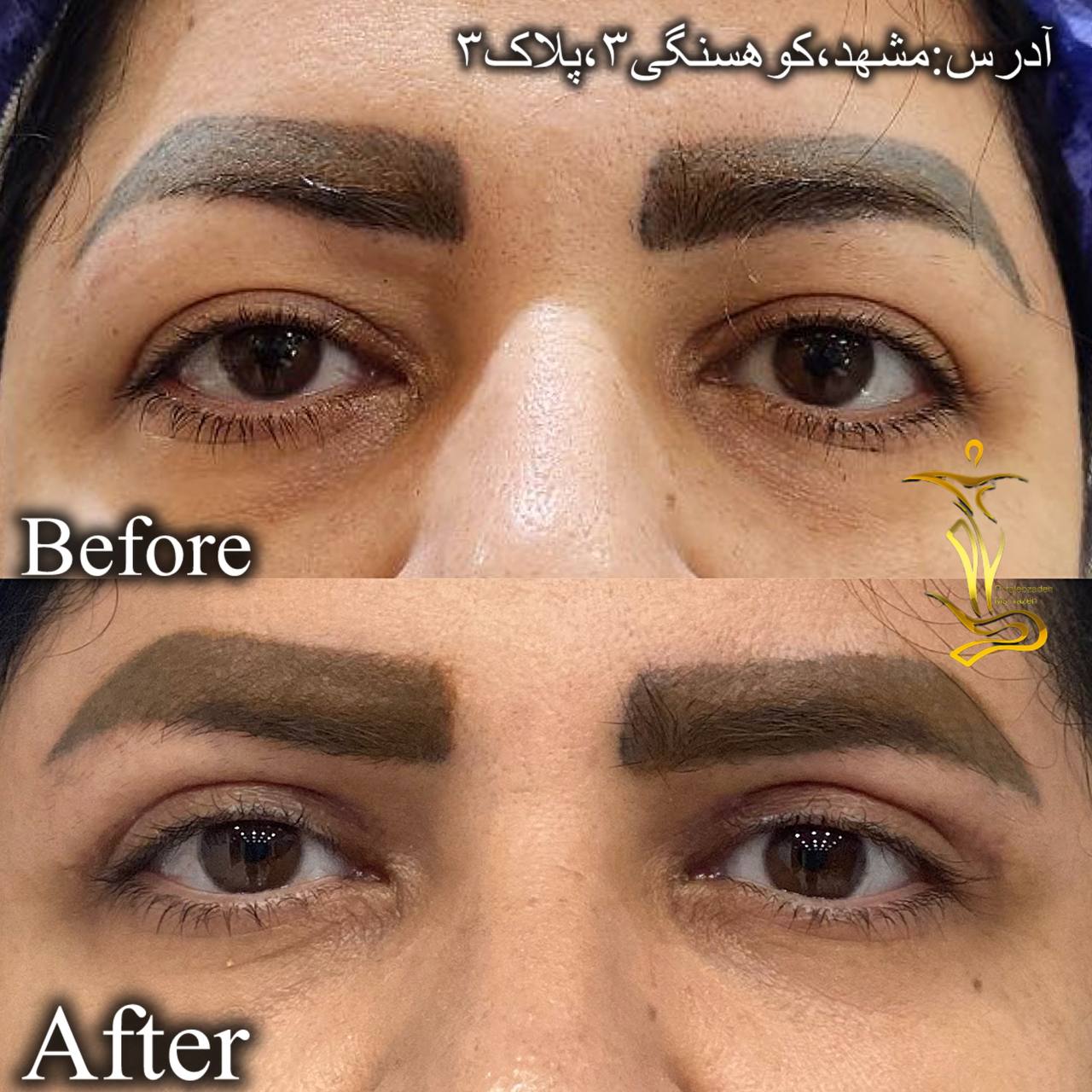 بلفاروپلاستی