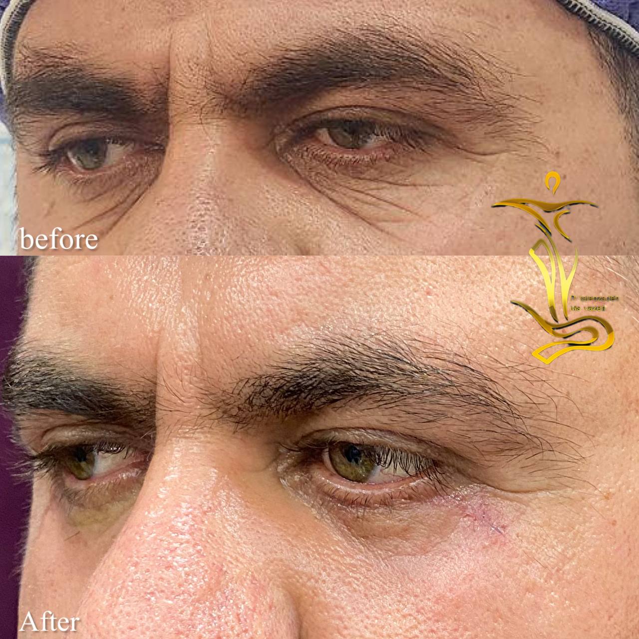 بلفاروپلاستی