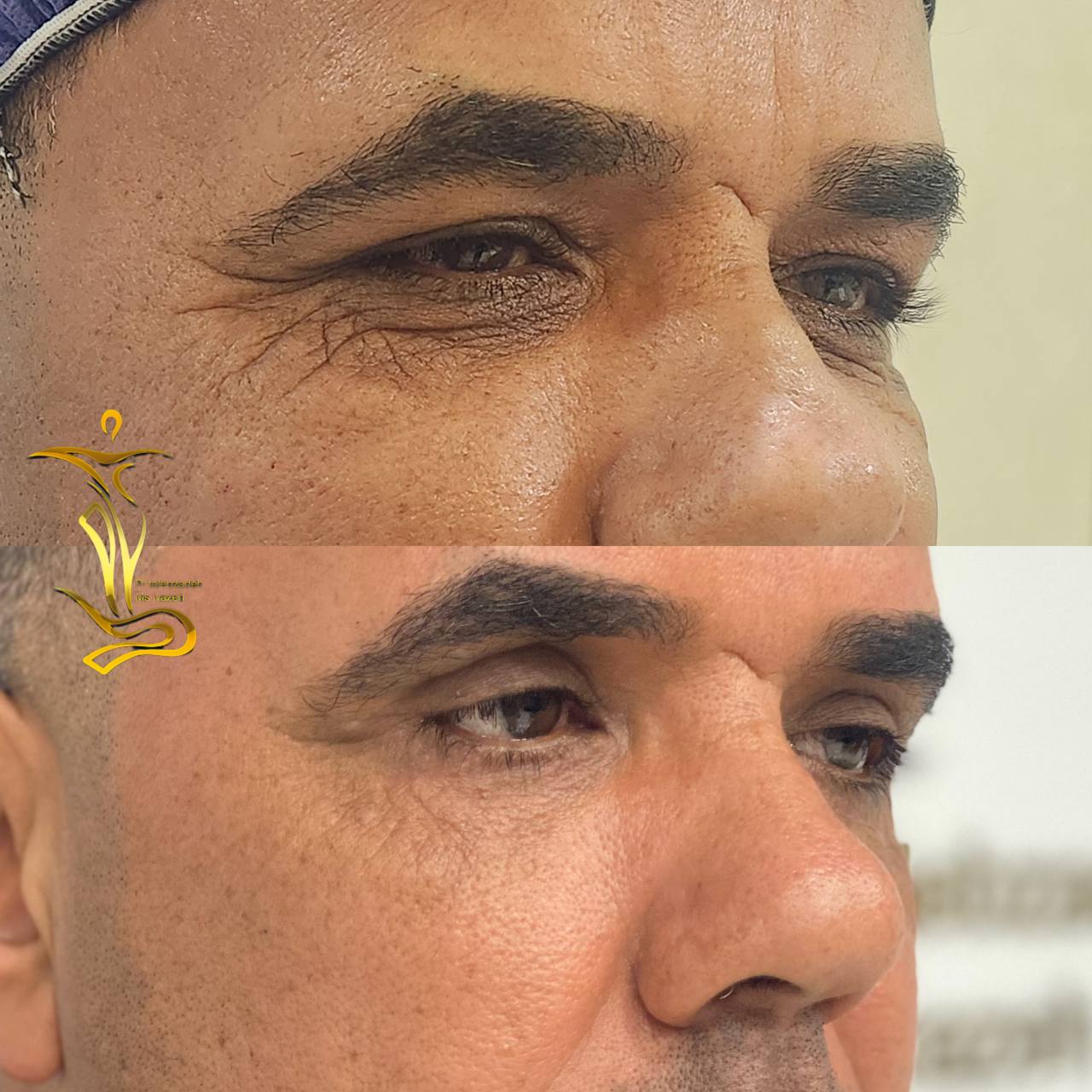 بلفاروپلاستی