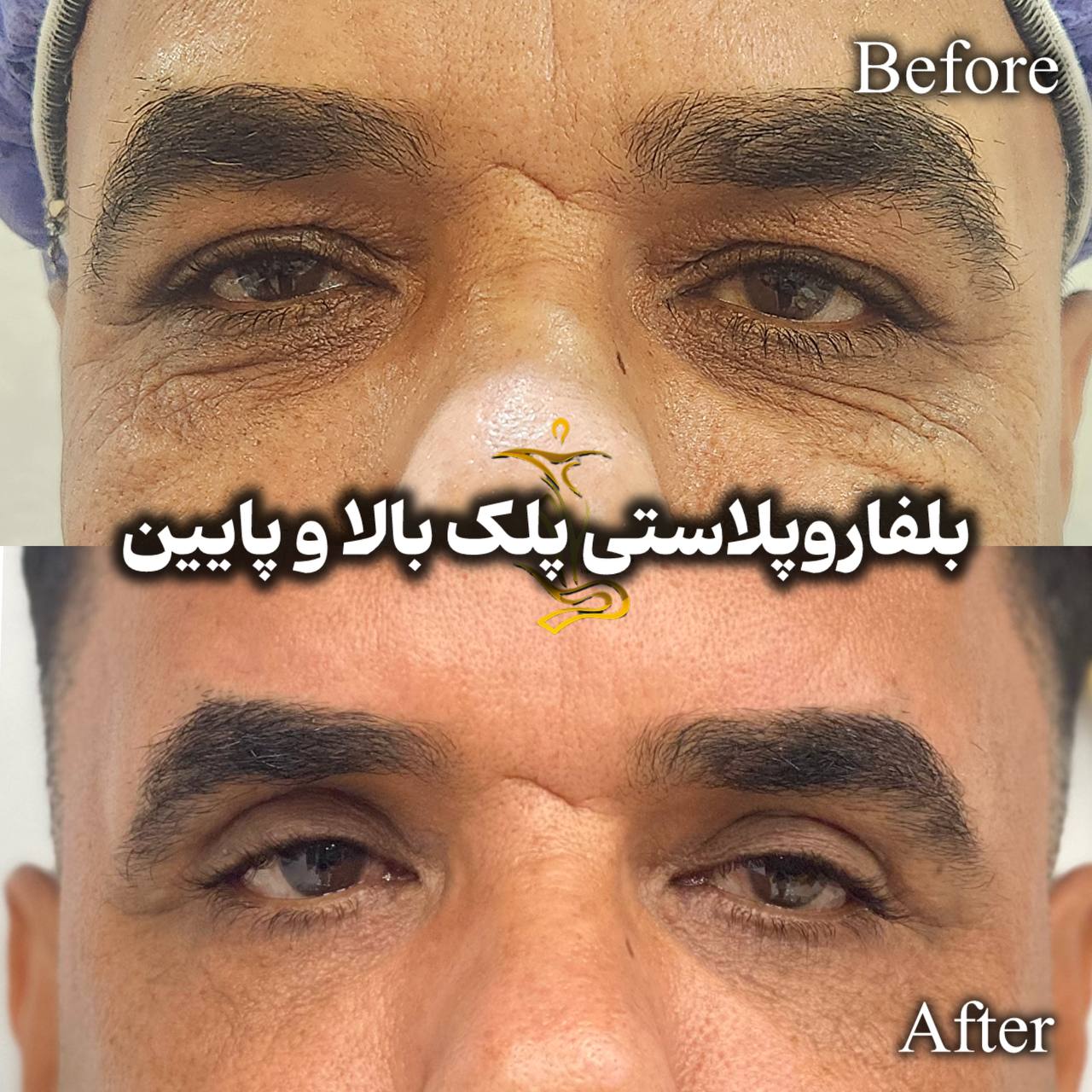 بلفاروپلاستی