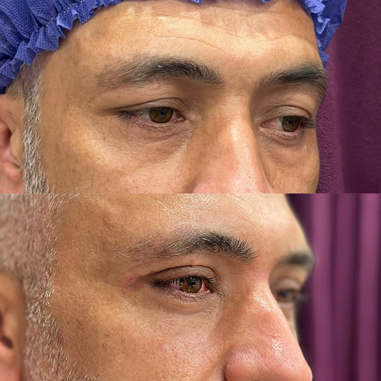 بلفاروپلاستی