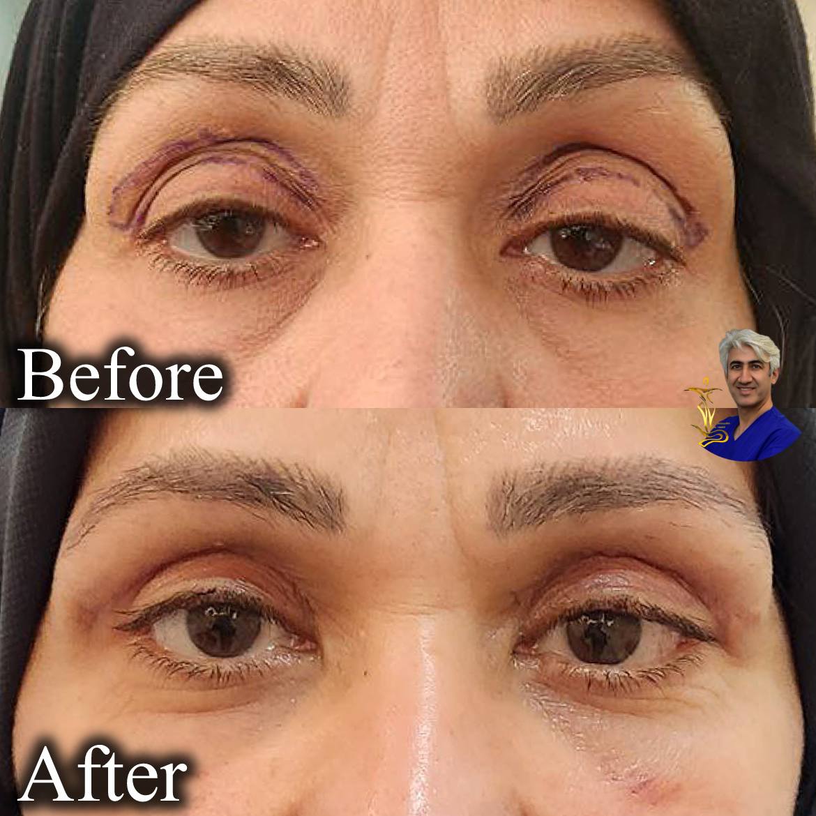 بلفاروپلاستی
