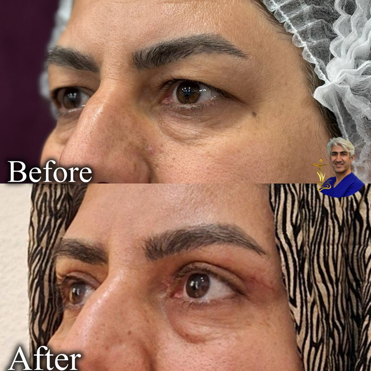 پلک بالا