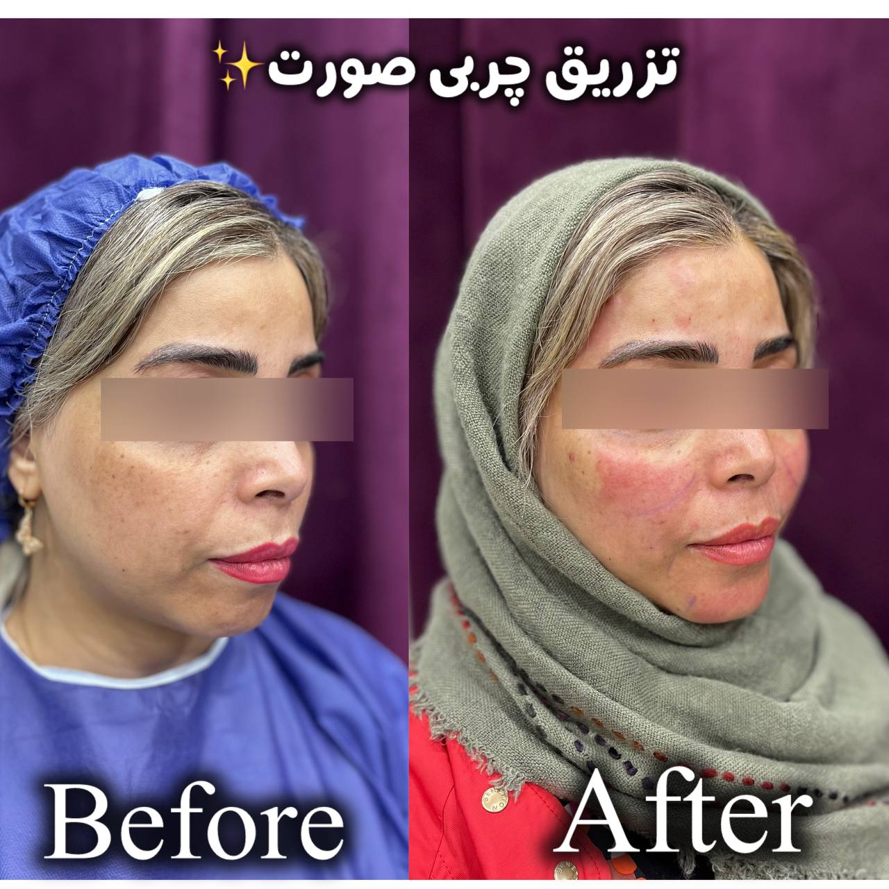تزریق چربی