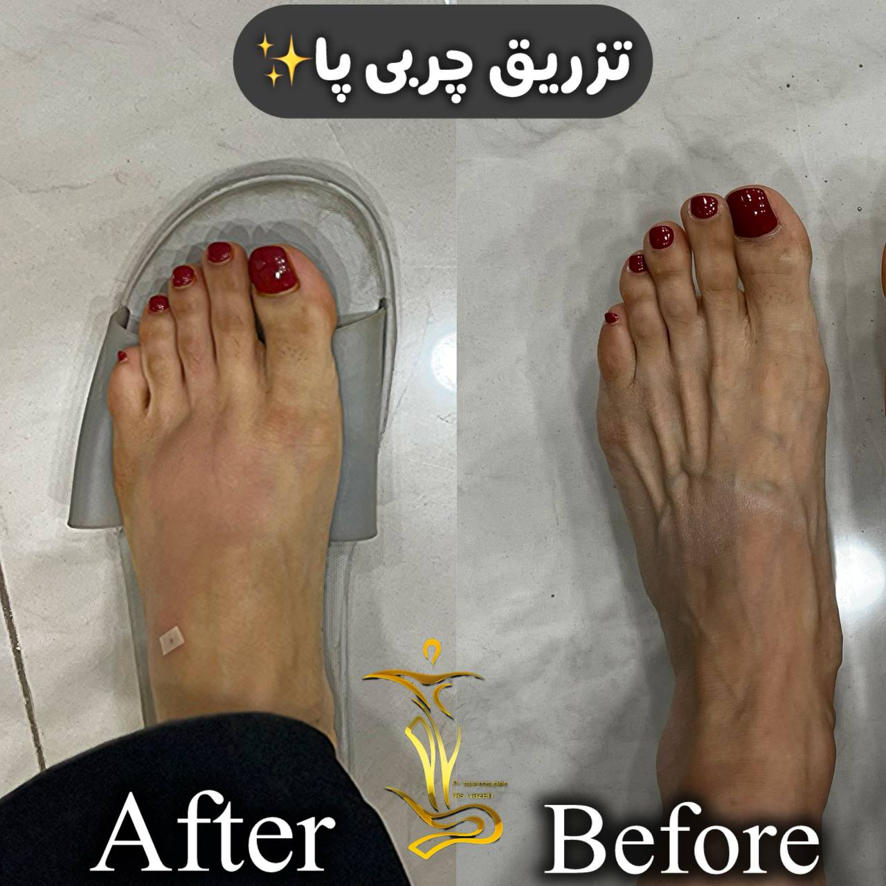 تزریق چربی