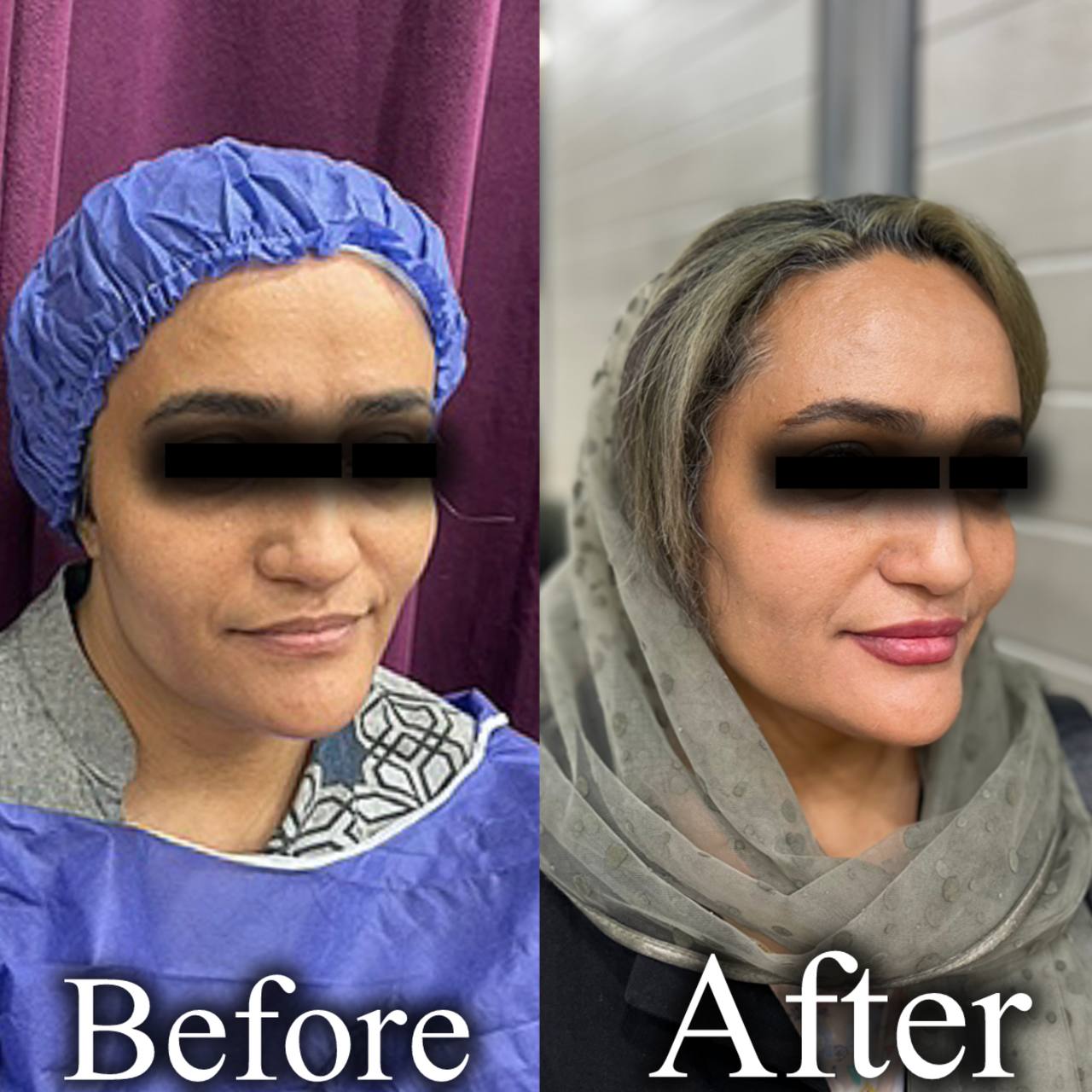 تزریق چربی