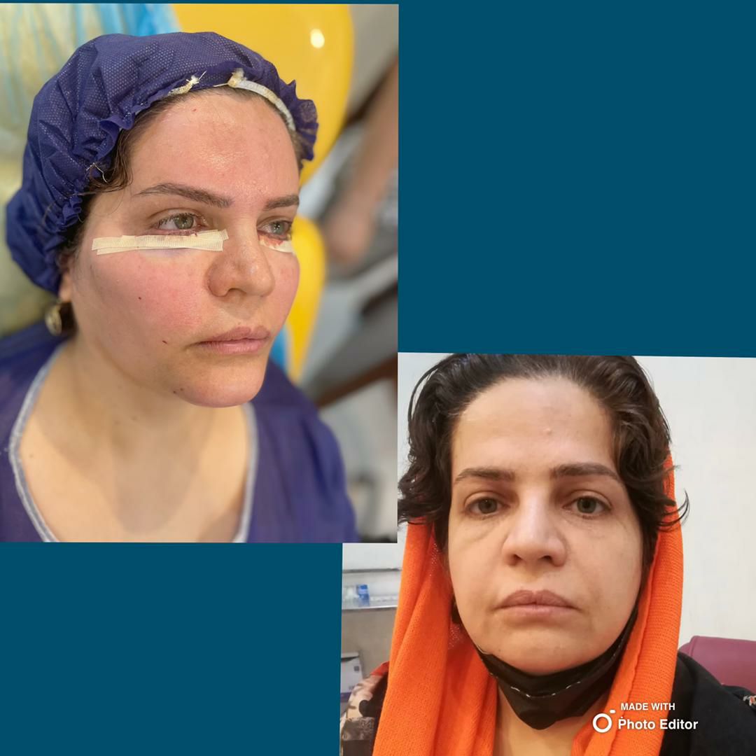 تزریق چربی