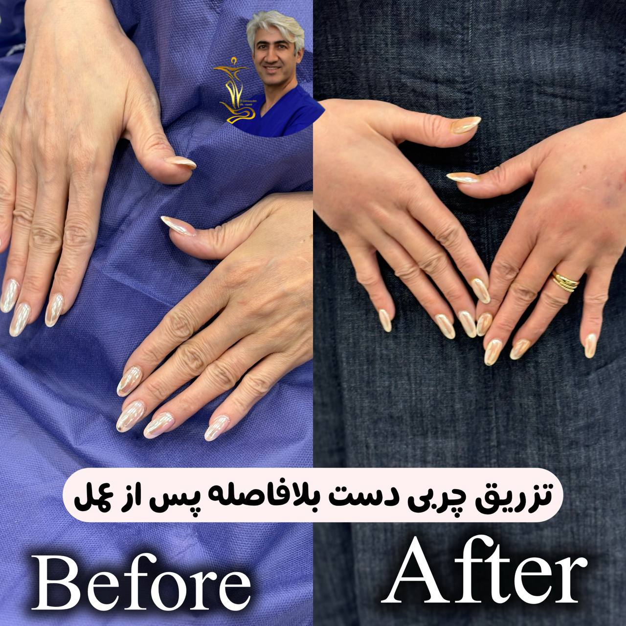تزریق چربی