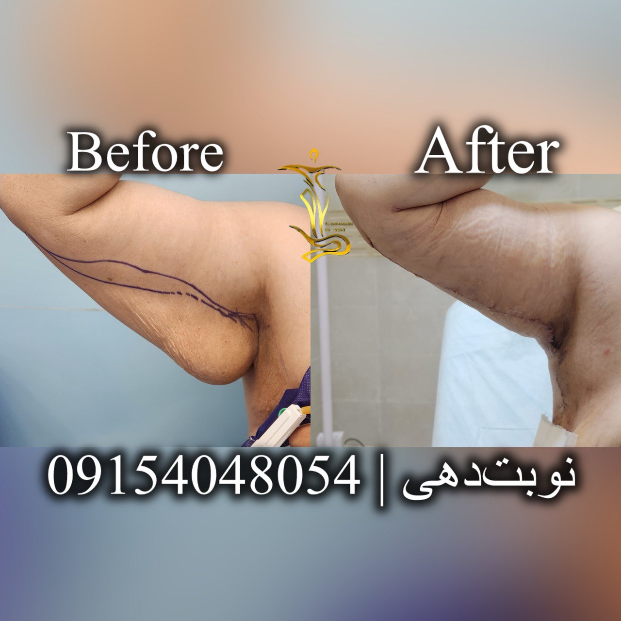 لیفت بازو