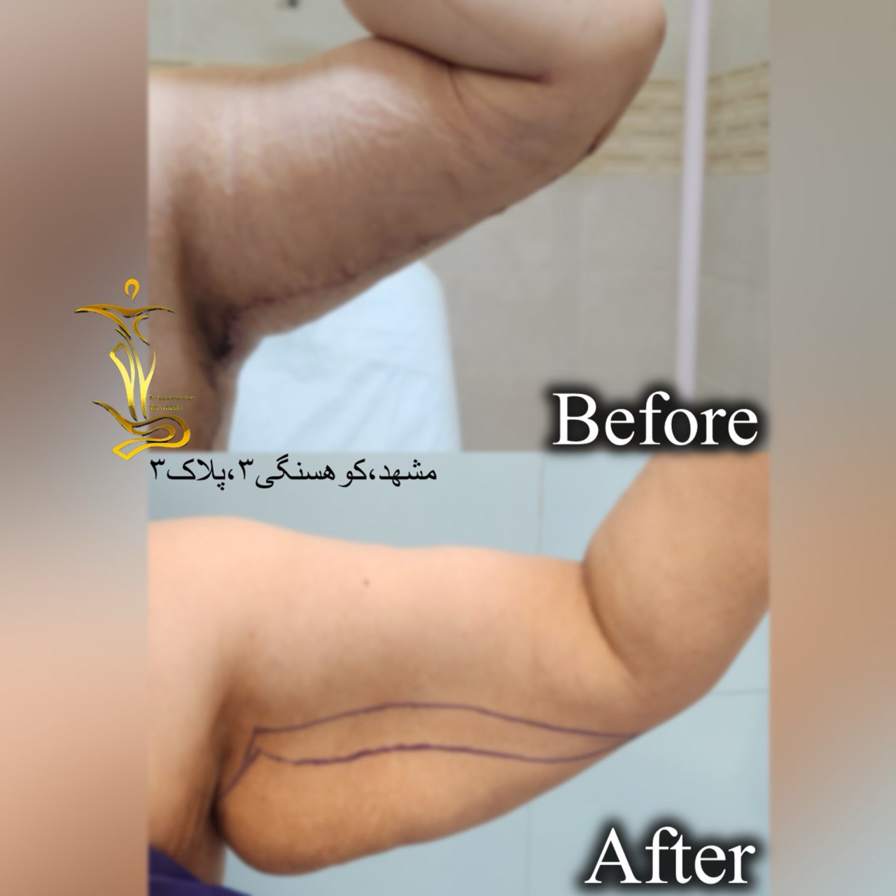 لیفت بازو