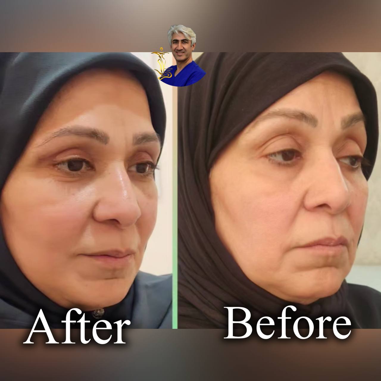 لیفت صورت و گردن