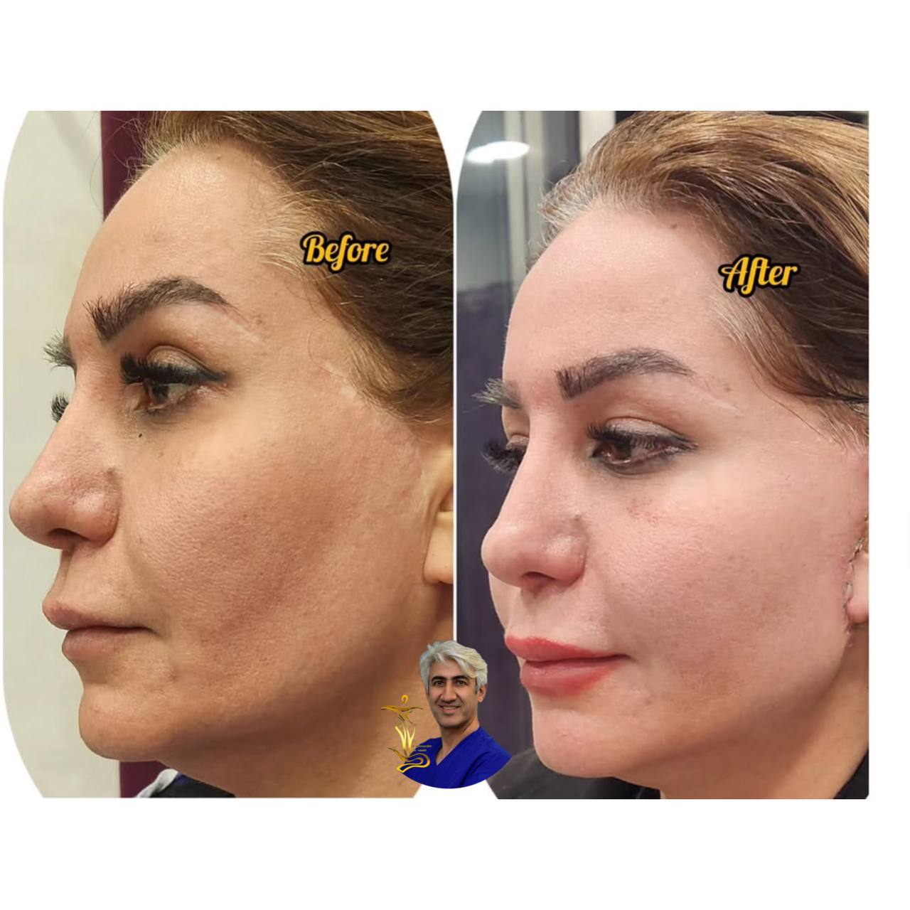 لیفت صورت و گردن
