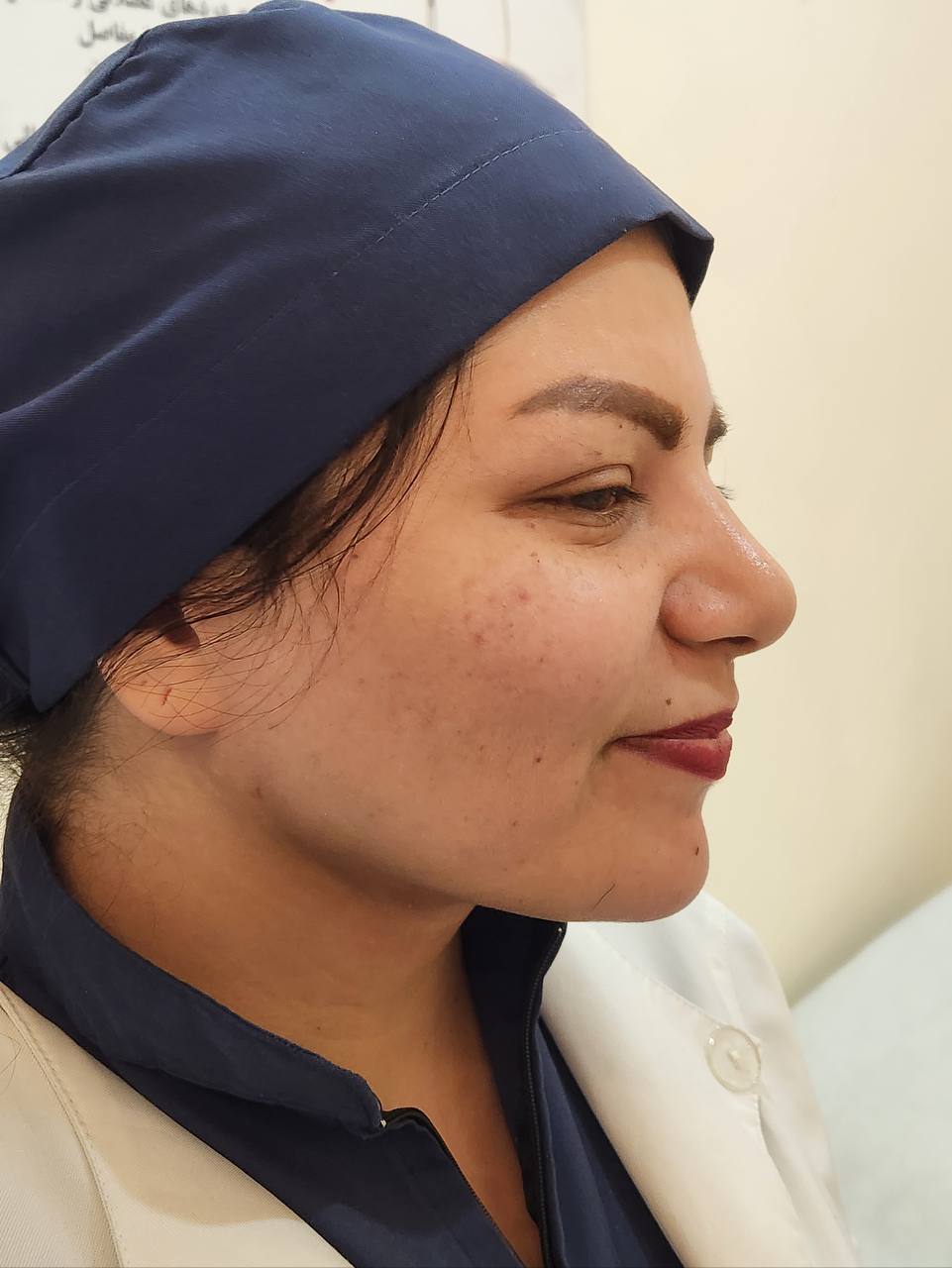 لیپوساکشن غبغب