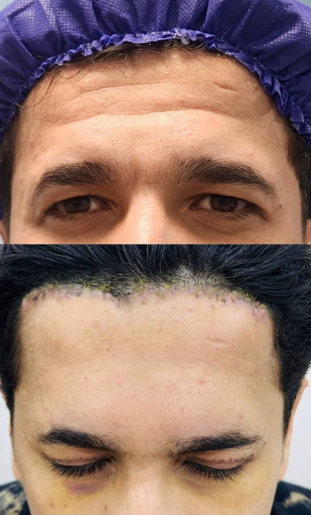 لیفت صورت و گردن