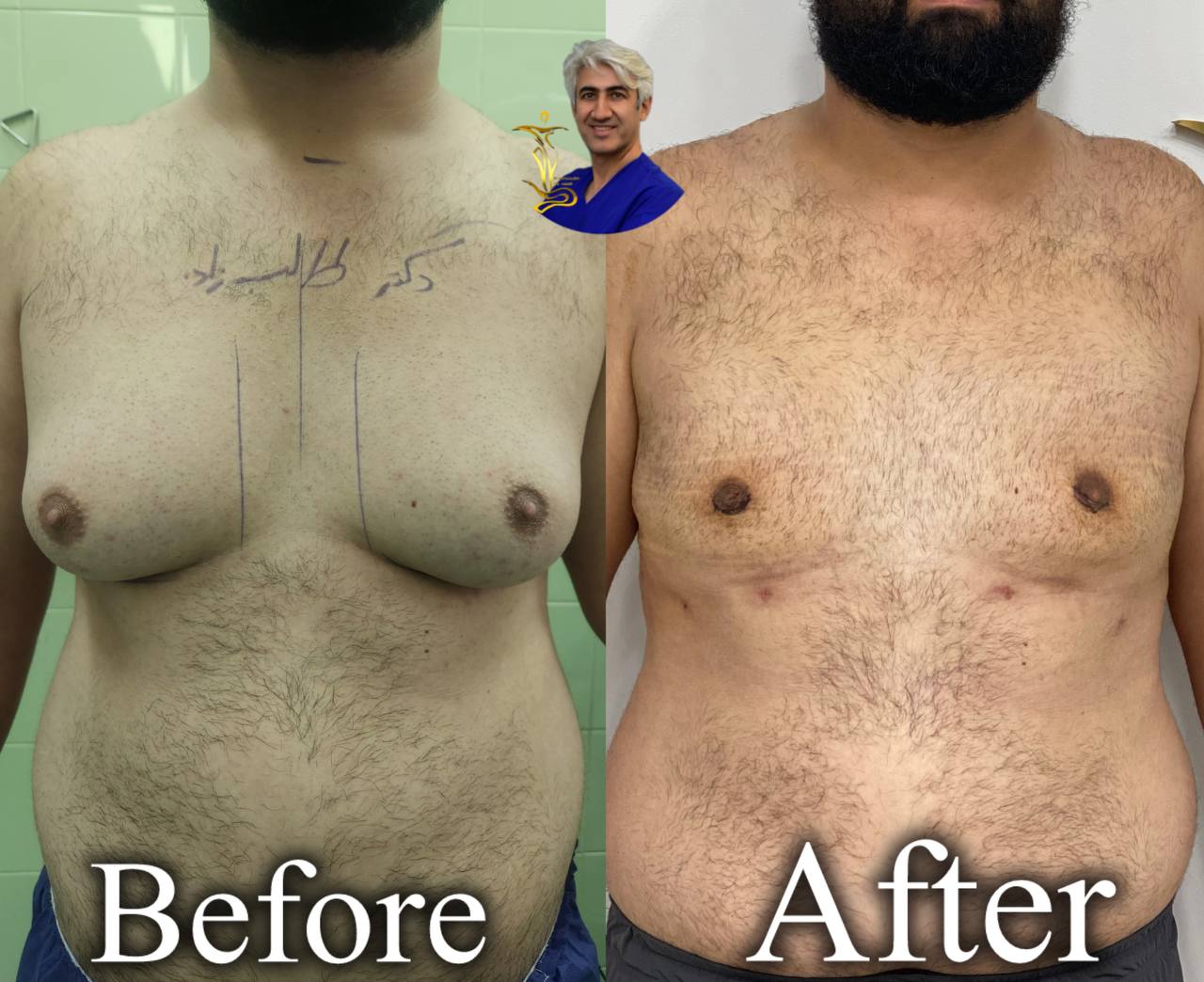 ژنیکوماستی
