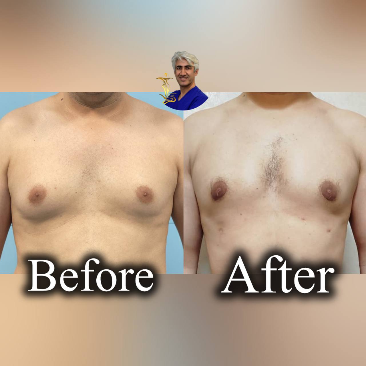 ژنیکوماستی
